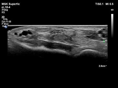 eL18-4 MSK Superficial Nerve