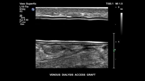 Venous dialysis access graft