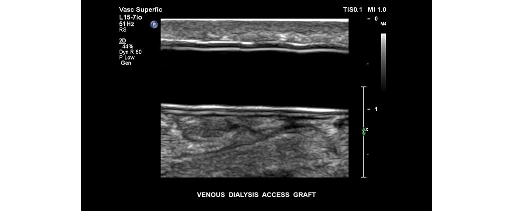 Venous dialysis access graft