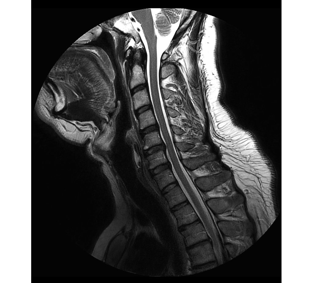 MultiVane XD - Sagittal T2w TSE