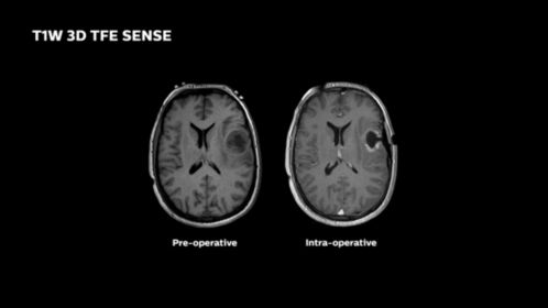T1W 3D TFE SENSE
