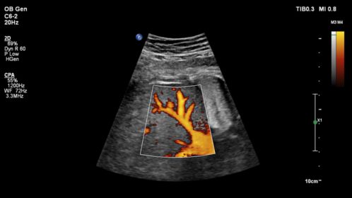 OB ultrasound image shown with CPA using C6-2 transducer