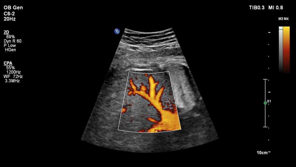 OB ultrasound image shown with CPA using C6-2 transducer