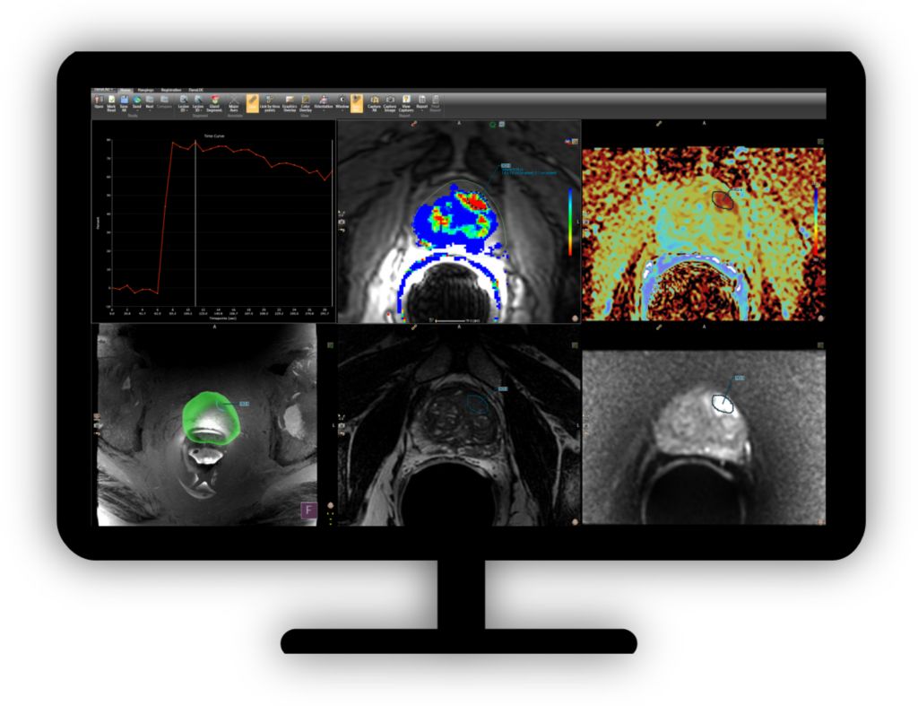 DynaCAD Prostate Advanced post-processing imaging system for Prostate MRI analysis