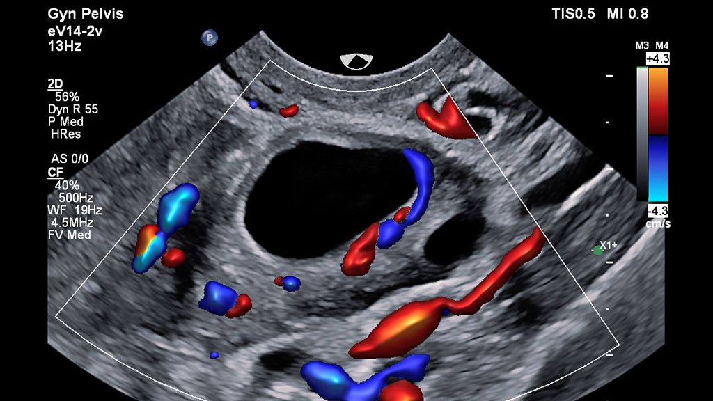 eV14-2v clinical image on EPIQ showing color for ovary 