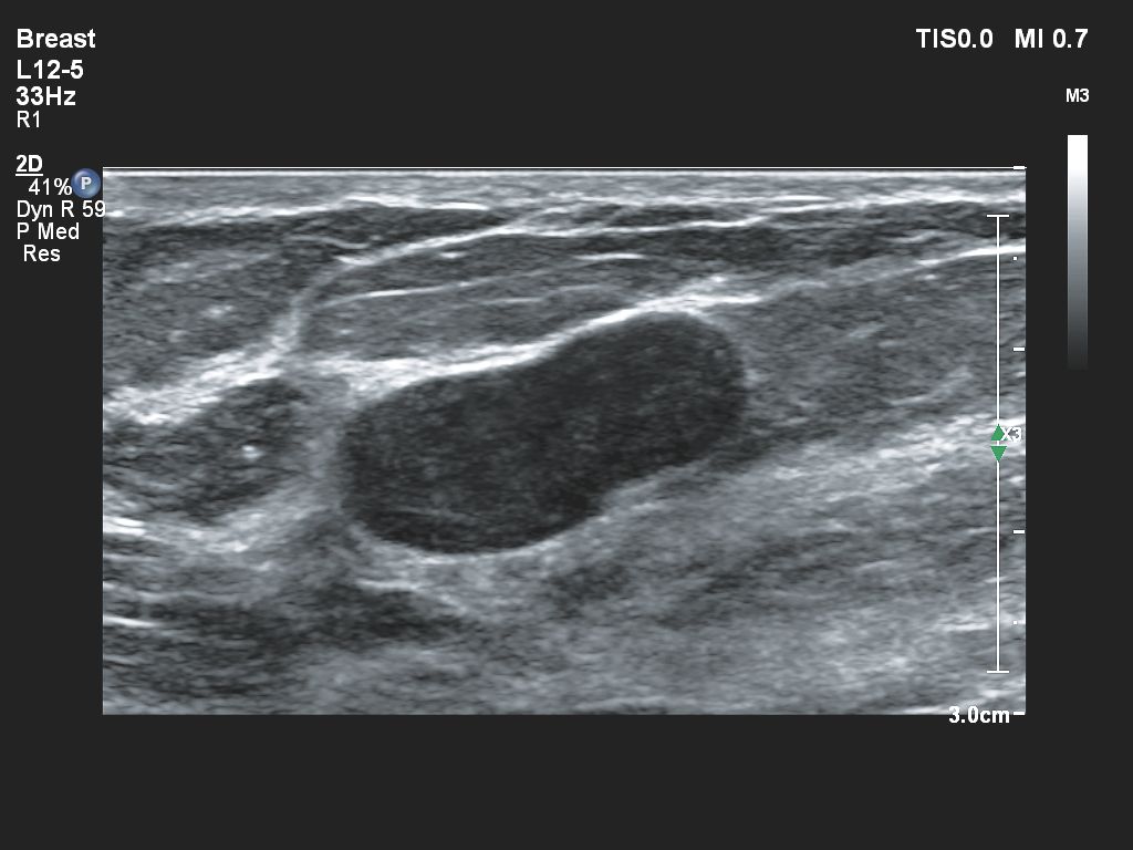 Affiniti 30 ultrasound clinical image breast