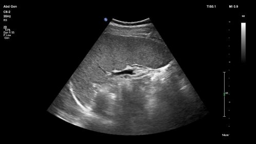 Spleen in 2D using C6-2 transducer