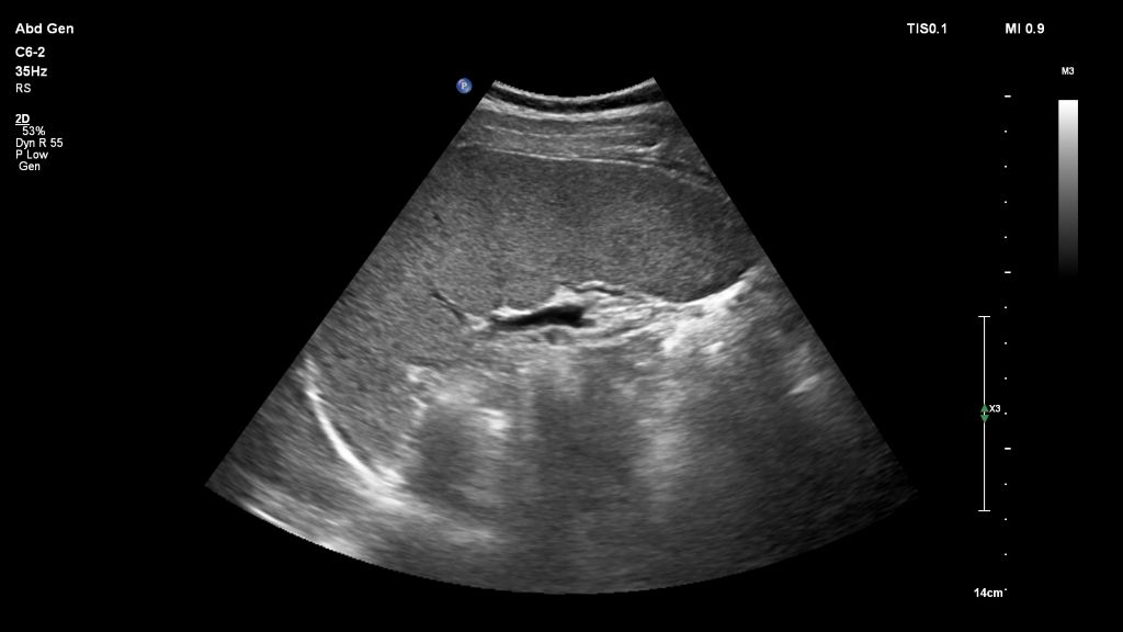Spleen in 2D using C6-2 transducer