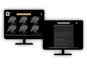 CT Calcium Automated Analysis Supports reporting coronary calcium extent on chest CT scans​