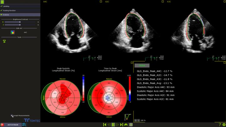 Automated strain measurements: LV-RV-LA - Philips