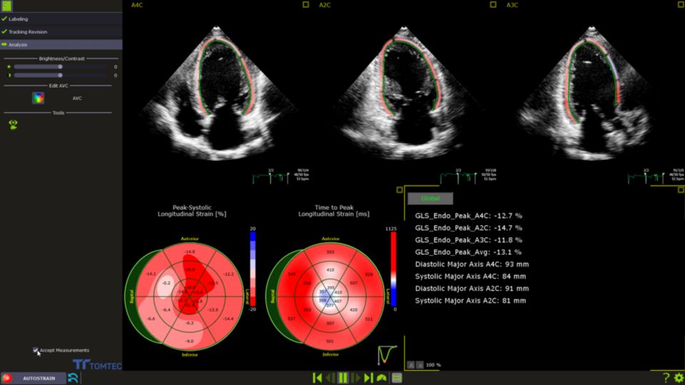Clinical Image - AutoStrain LV– Affiniti CVX