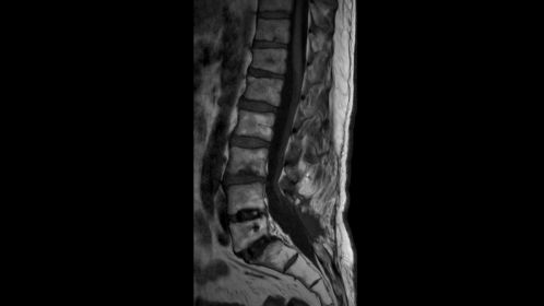 Sagittal T1w TSE (post surgical)