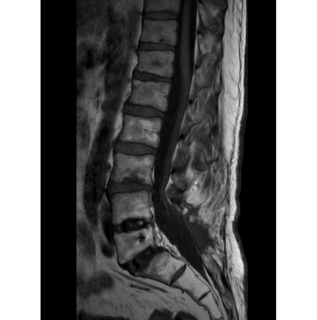 Sagittal T1w TSE (post surgical)