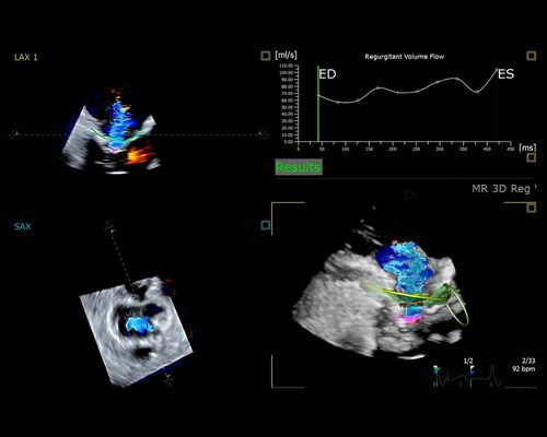 Ultrasound, application, ai, cfq, color flow quantification