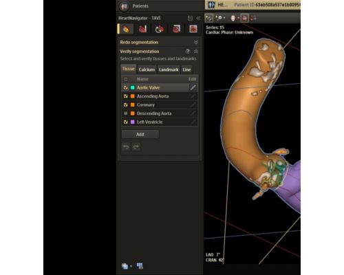 Philips HeartNavigator
