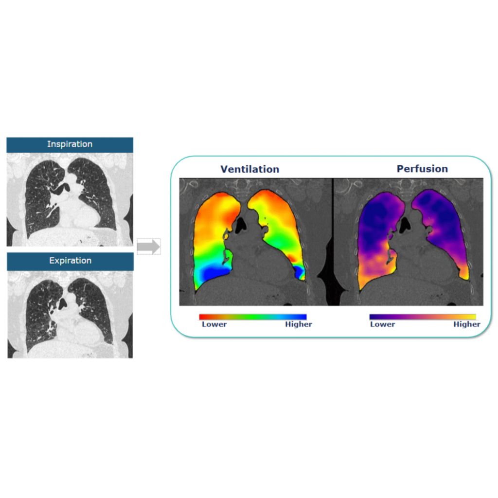 Non-contrast ventilation and perfusion imaging from standard chest CTs