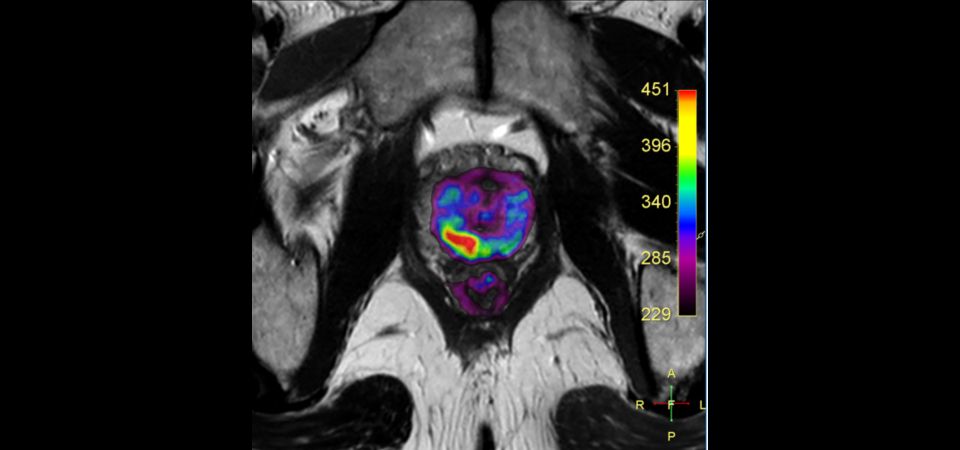 Axial Diffusion (fusion b800 DWI + T2w TSE)