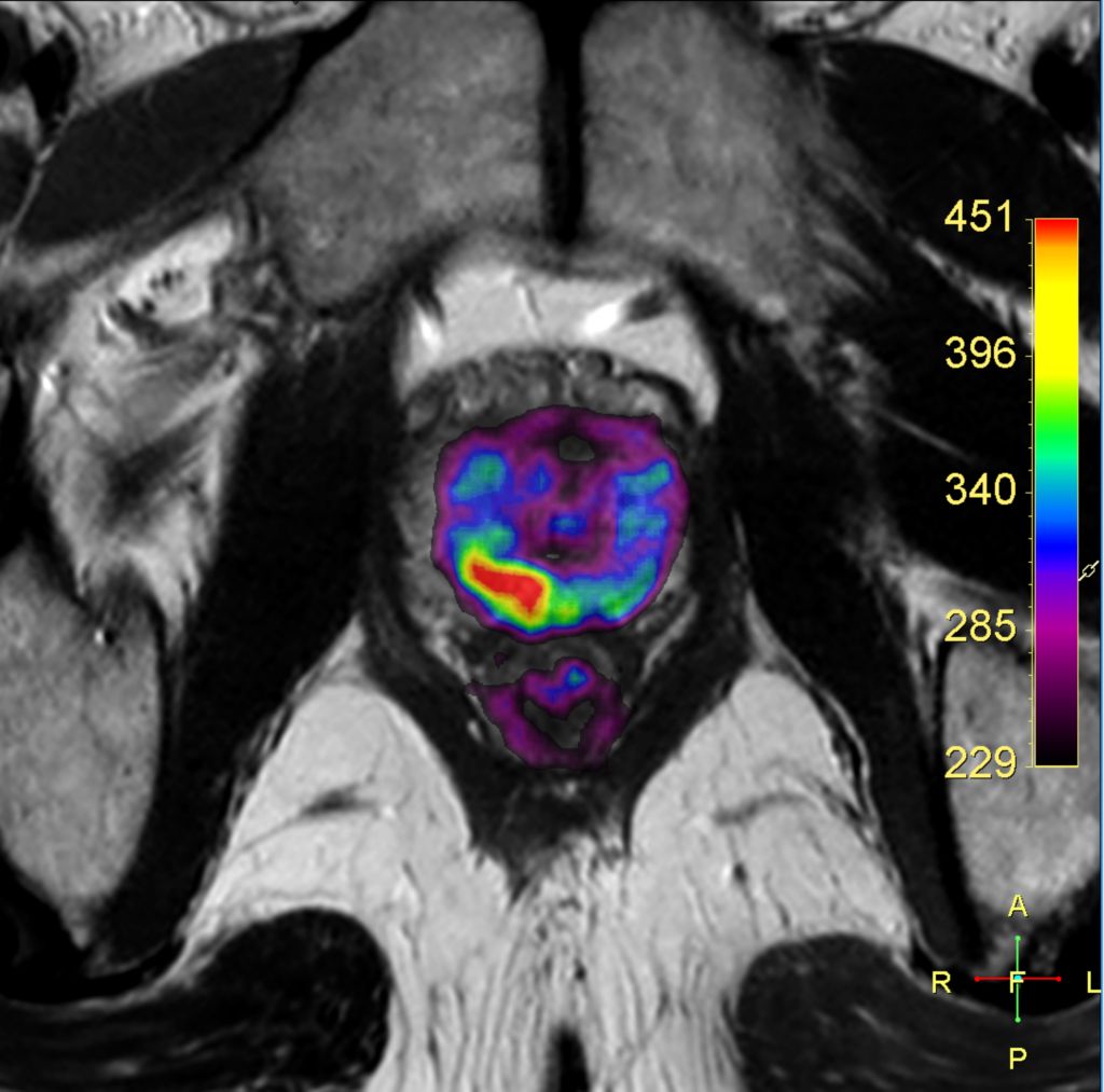 Axial Diffusion (fusion b800 DWI + T2w TSE)