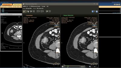 Philips IQon Spectral CT — Клинические исследования на IQon Spectral CT — фото 3