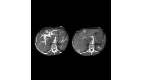 CBCT Dual em imagens do fígado