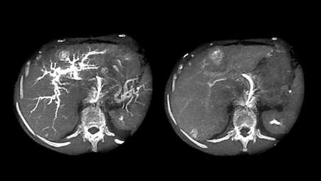 CBCT Dual em imagens do fígado