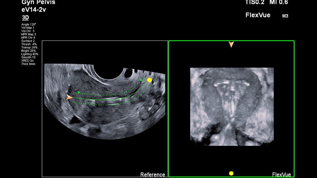 eV14-2v clinical image on EPIQ showing 3D IUD of pelvis using FlexVue