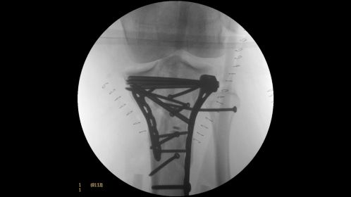 Clinical Image Philips BV Mobile C-arm Pulsera