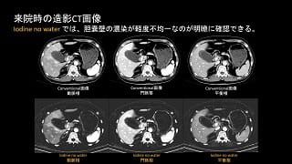 case 82
壊疽性胆嚢炎の診断