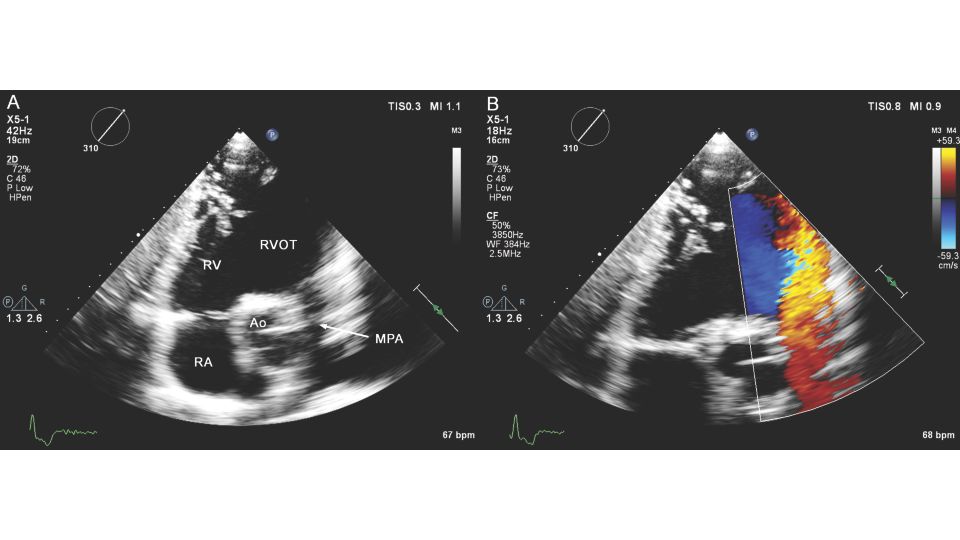 iRotate, CV Ultrasound