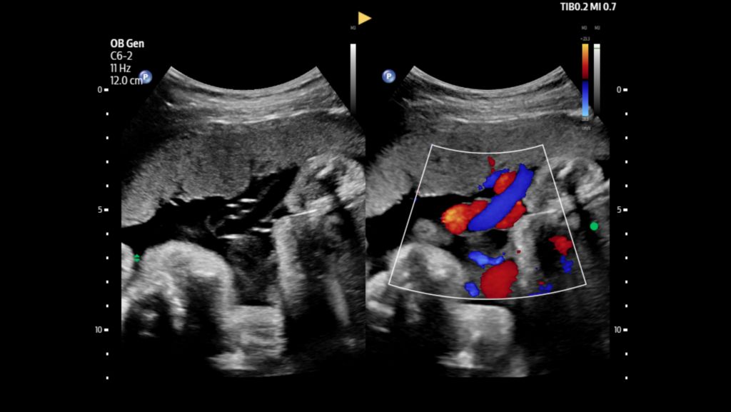 Umbilical cord with and without color flow Doppler shown using C6-2 transducer and dual imaging capability.
