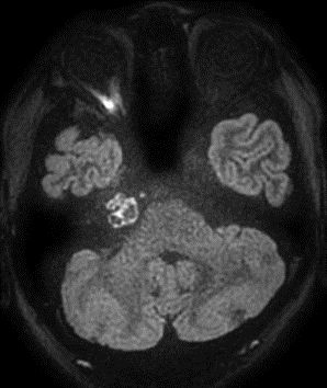 Philips - DWI XD TSE - Brain MR clinical application - Philips