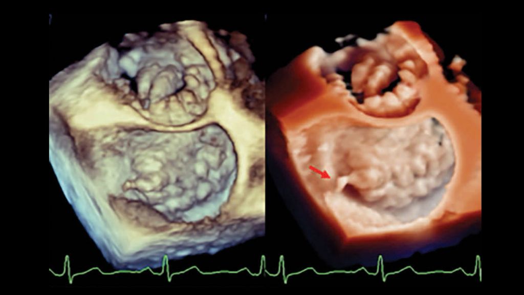 Clinical image – TrueVue - Enhanced visualization in diffuse degenerative mitral valve disease