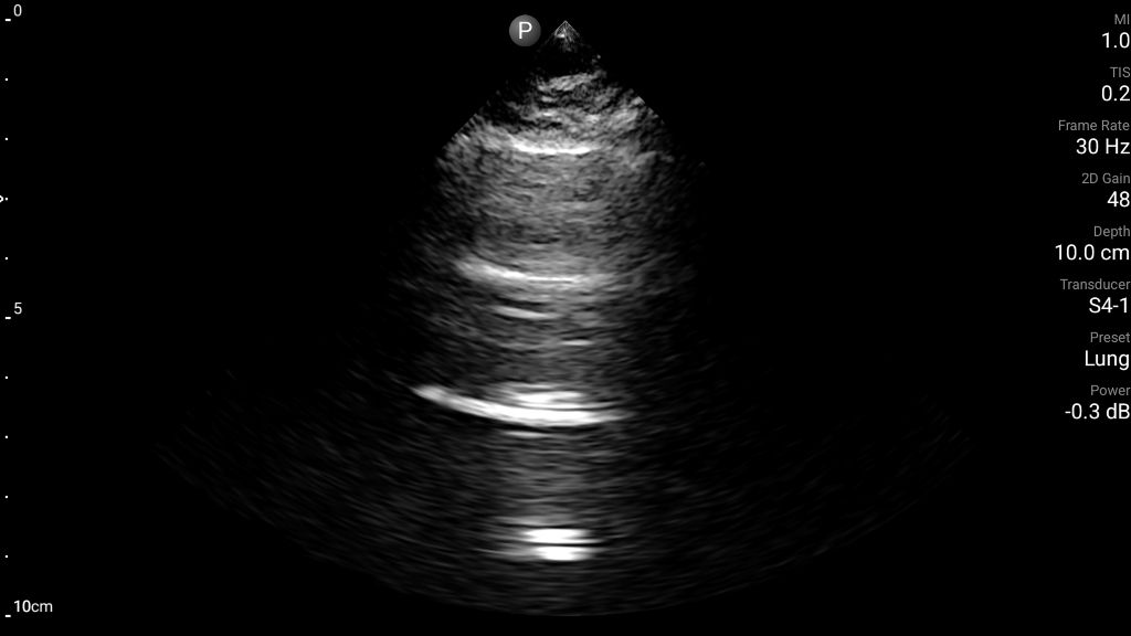 Lung ultrasound shown with S4-1 transducer.