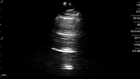Lung ultrasound shown with S4-1 transducer.