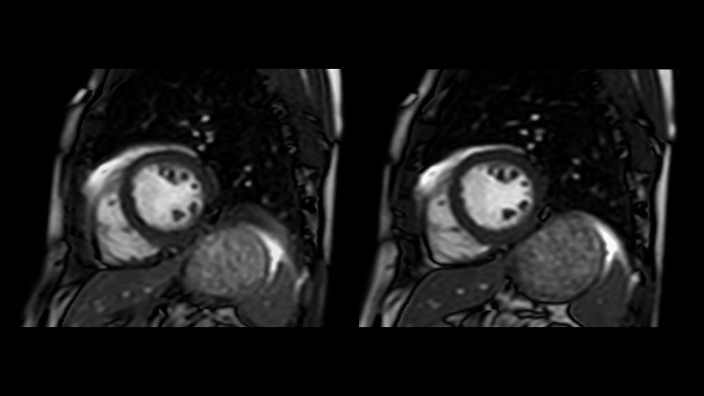 bTFE CINE - no gate versus CINE FreeBreathing