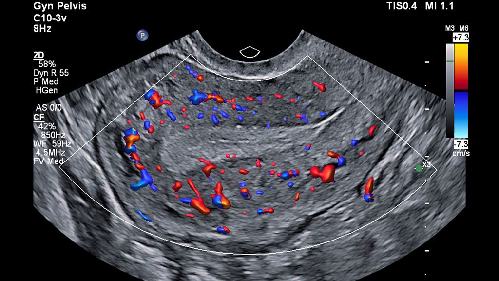 C10-3v clinical image on EPIQ showing color for uterus