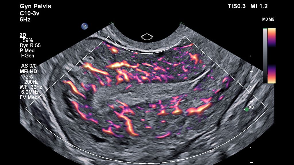 C10-3v clinical image on EPIQ system showing pelvis using MFI HD  