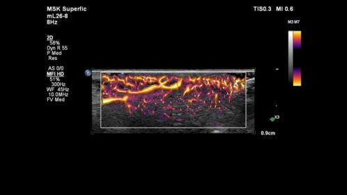 mL26-8 MSK Superficial Perfusion with MFI HD
