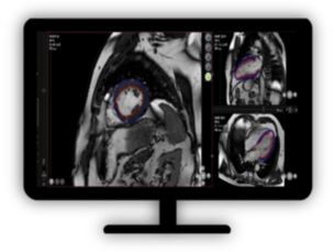 MR Caas Strain Quantify myocardial strain