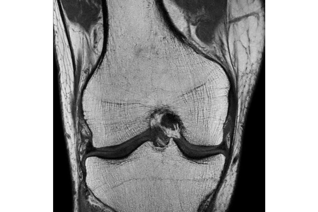 Coronal T1w TSE