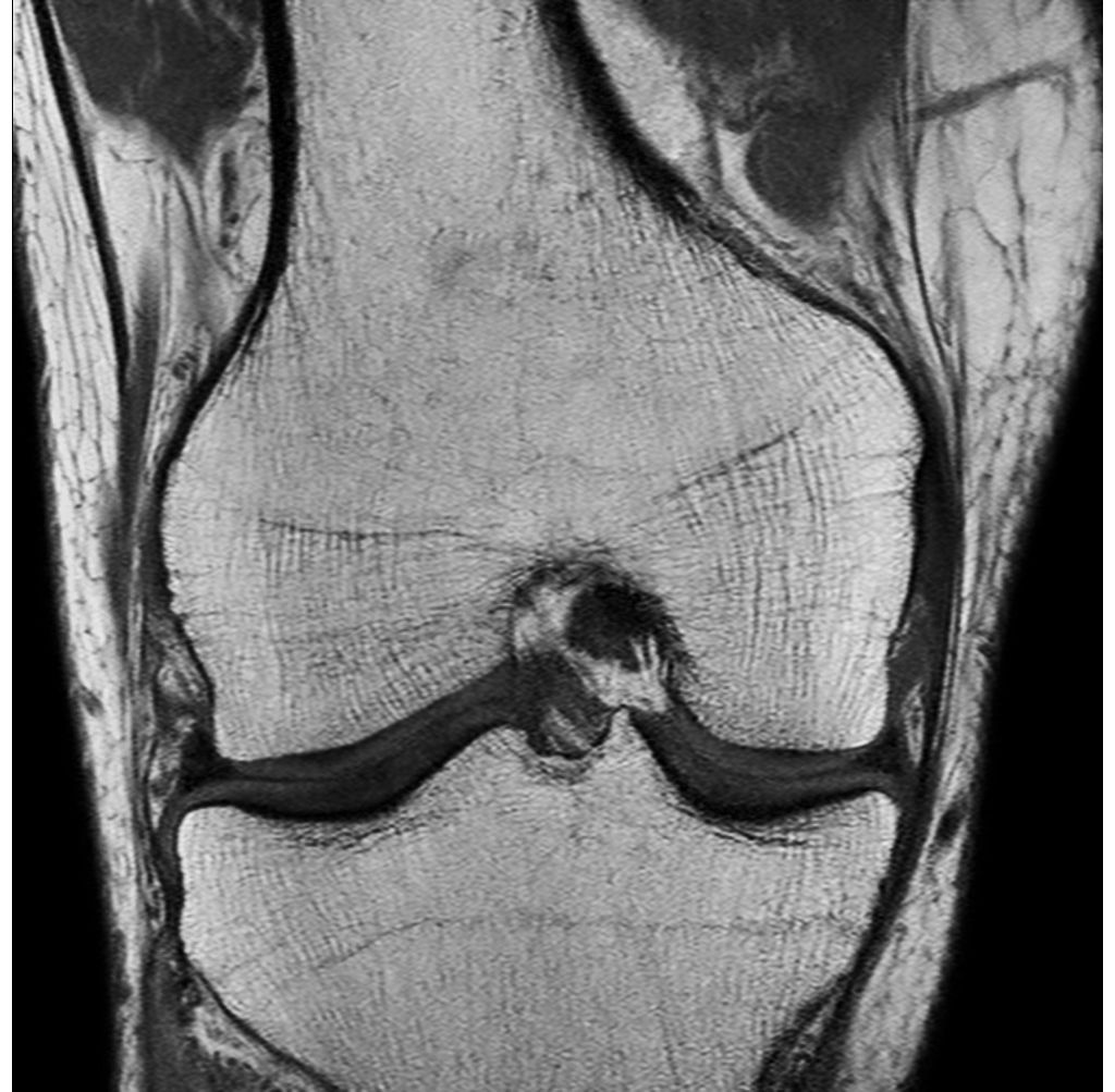 Coronal T1w TSE