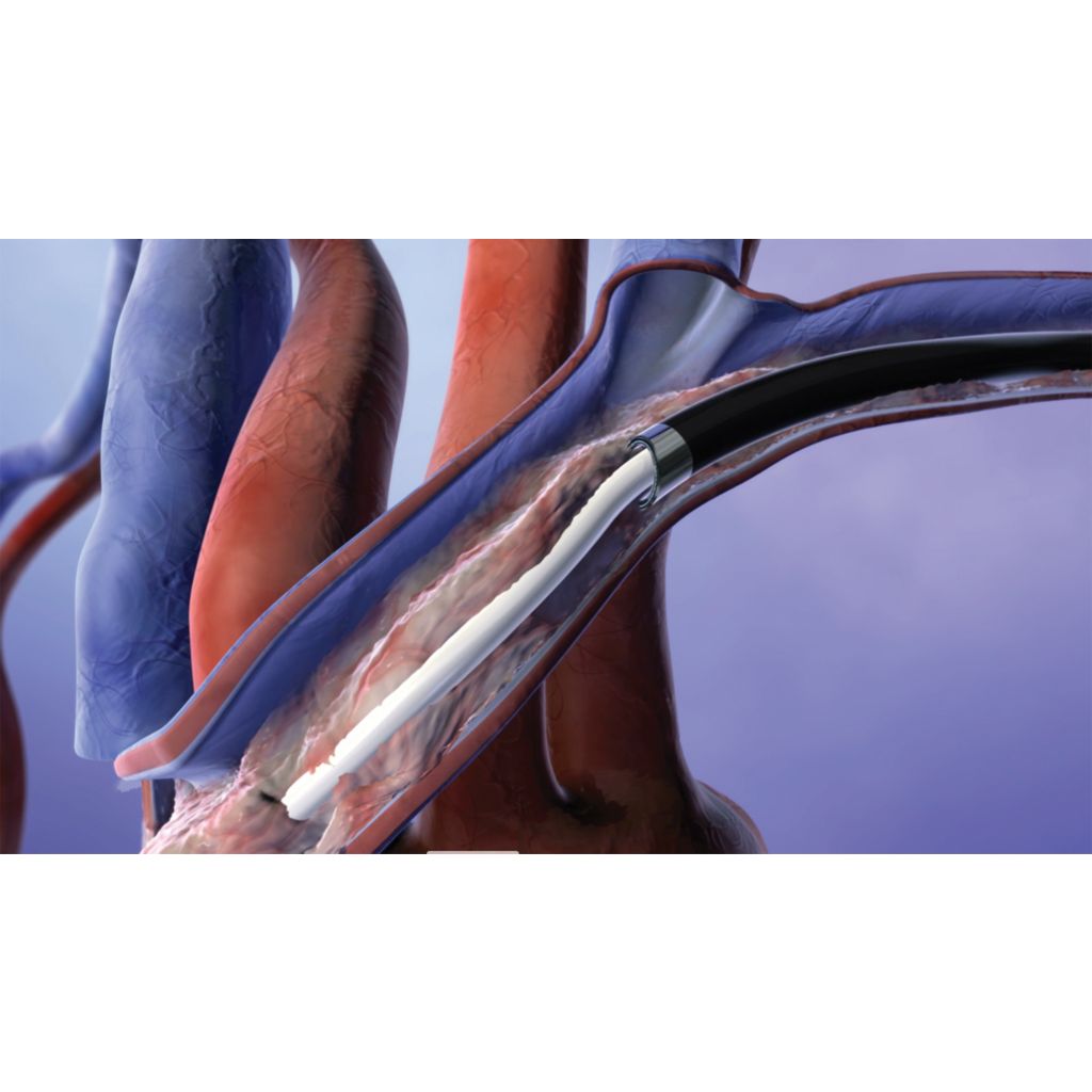 Lead management procedures