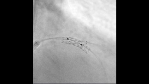 Enhanced image of a bifurcation stent in the left coronary artery