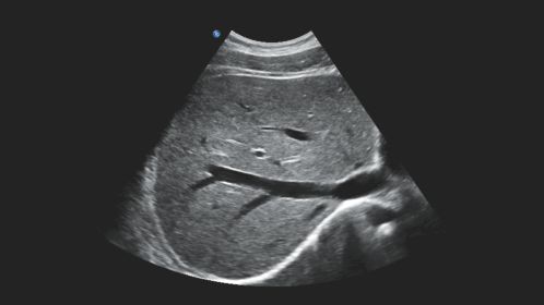 Transverse liver with hepatic veins