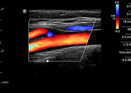 Carotid artery bifurcation with color Doppler shown using L12-4 transducer.