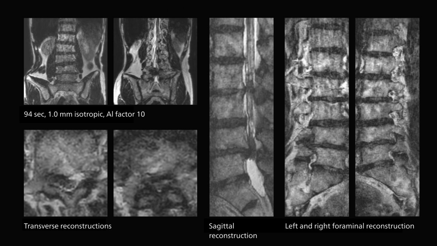 AI enabled Fast lumbar spine imaging for successful exam of patient in pain