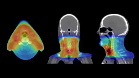 Accuracy in dose planning