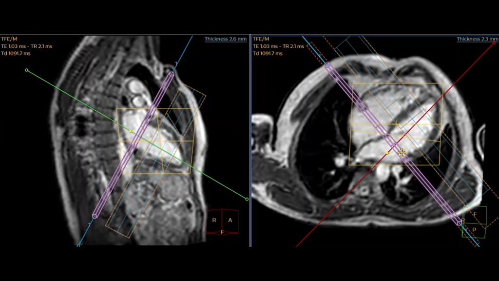 Cardiac Quant Perfusion dual sequence planning