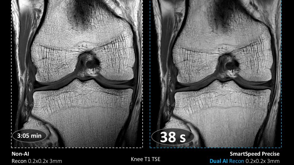 SmartSpeed Precise Knee comparison with Elition X

