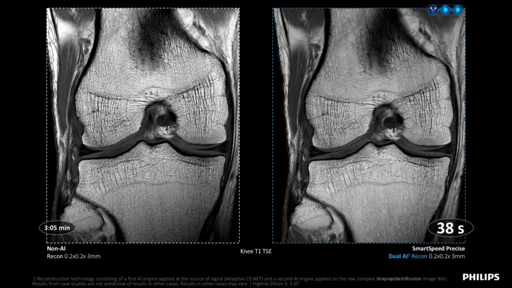 SmartSpeed Precise speed comparion -  Knee